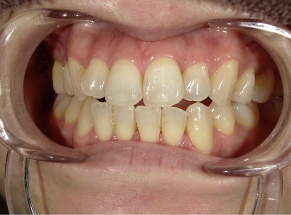 ホワイトニング前後の比較