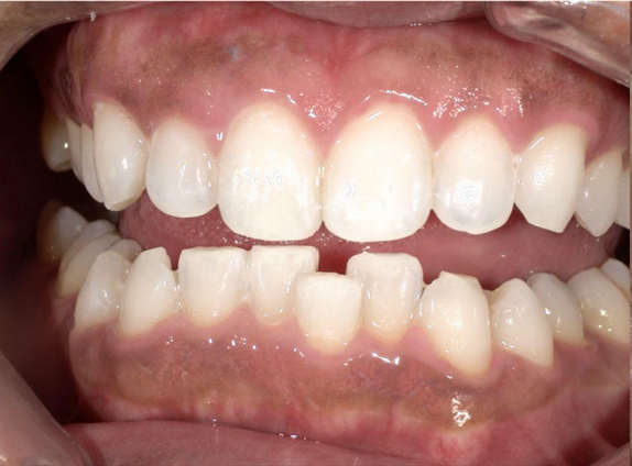 ホワイトニング前後の比較