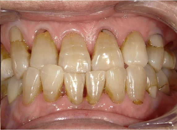 ホワイトニング前後の比較