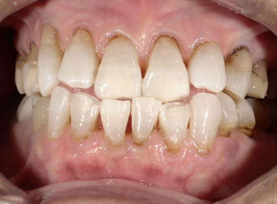 ホワイトニング前後の比較