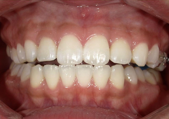 ホワイトニング前後の比較