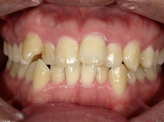 ホワイトニング前後の比較