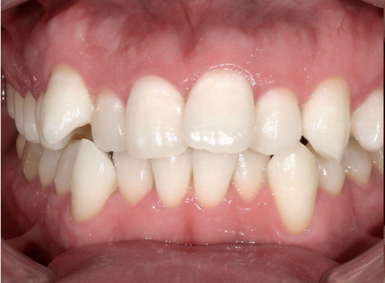 ホワイトニング前後の比較