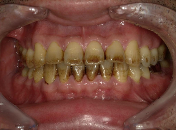 ホワイトニング前後の比較