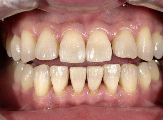 ホワイトニング前後の比較