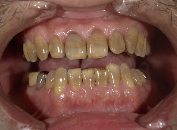 ホワイトニング前後の比較