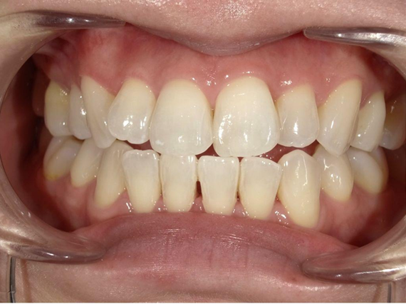 ホワイトニング前後の比較