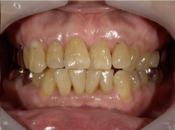 ホワイトニング前後の比較