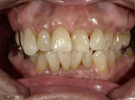 ホワイトニング前後の比較