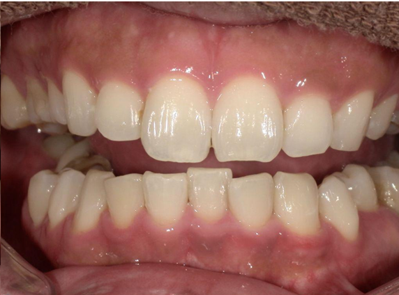 ホワイトニング前後の比較