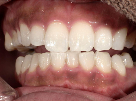 ホワイトニング前後の比較