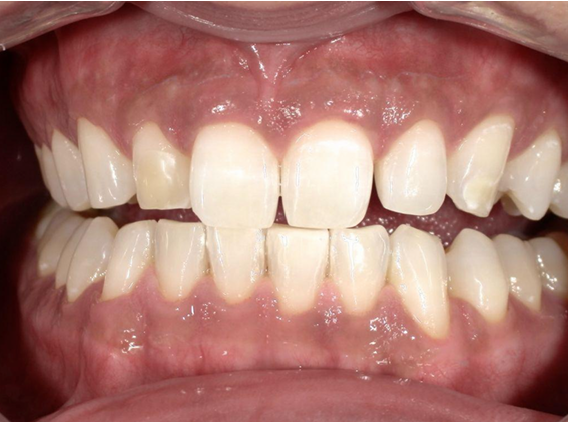 ホワイトニング前後の比較