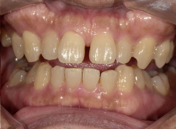 ホワイトニング前後の比較