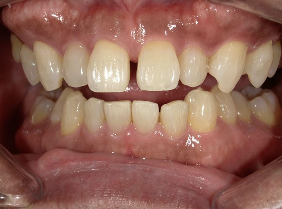 ホワイトニング前後の比較