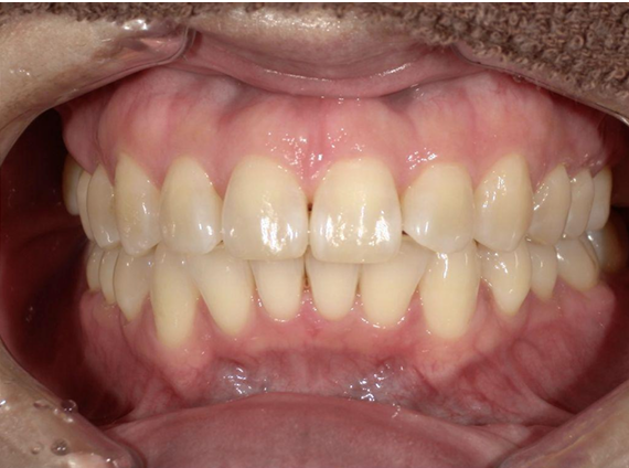 ホワイトニング前後の比較