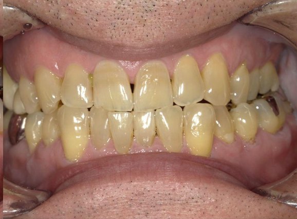 ホワイトニング前後の比較