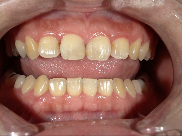 ホワイトニング前後の比較