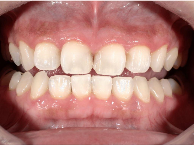 ホワイトニング前後の比較