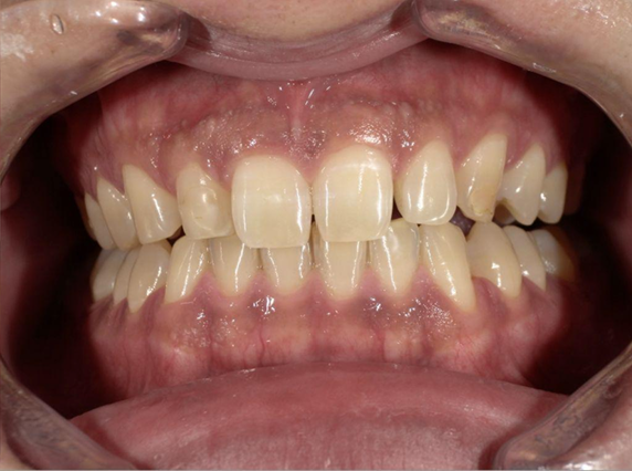 ホワイトニング前後の比較