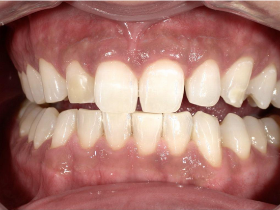 ホワイトニング前後の比較