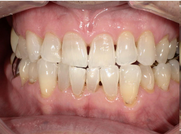 ホワイトニング前後の比較