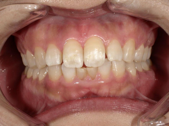 ホワイトニング前後の比較