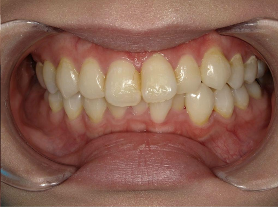 ホワイトニング前後の比較