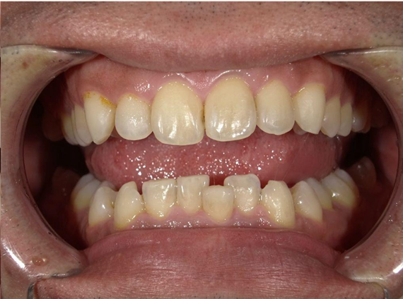 ホワイトニング前後の比較